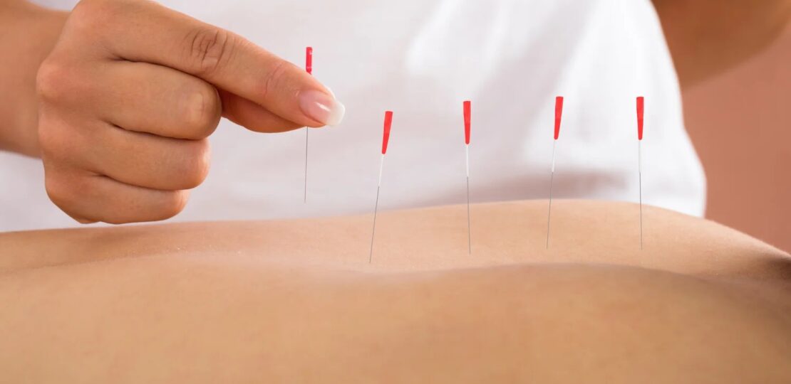 Dry-Needling