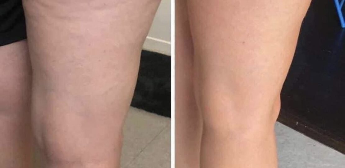 Lipedema-Treatment-in-Riyadh-17
