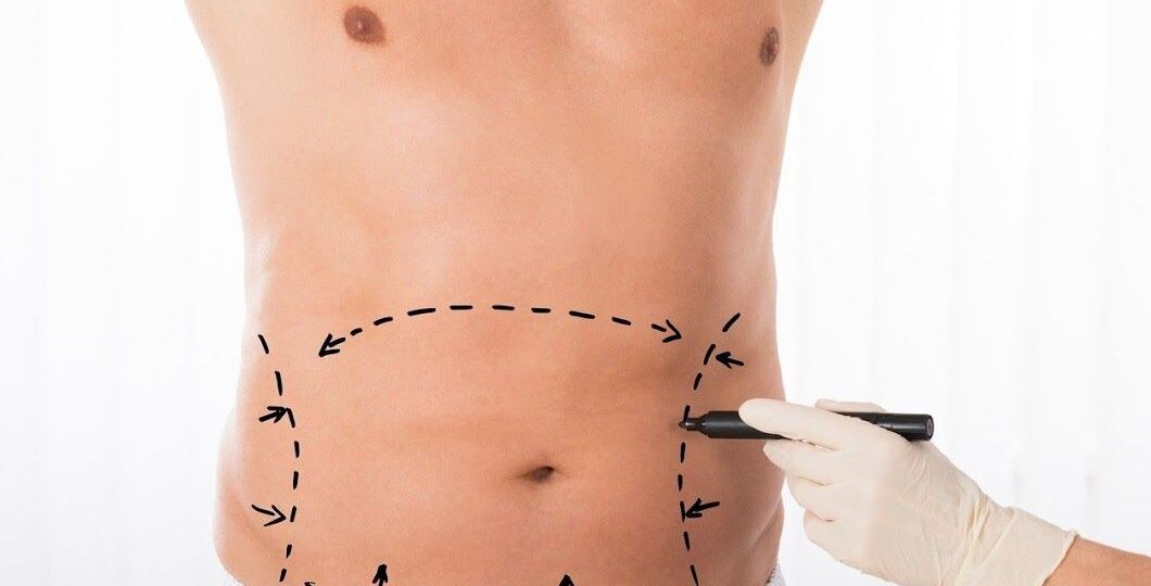 Laser-Liposuction-in-Riyadh-5