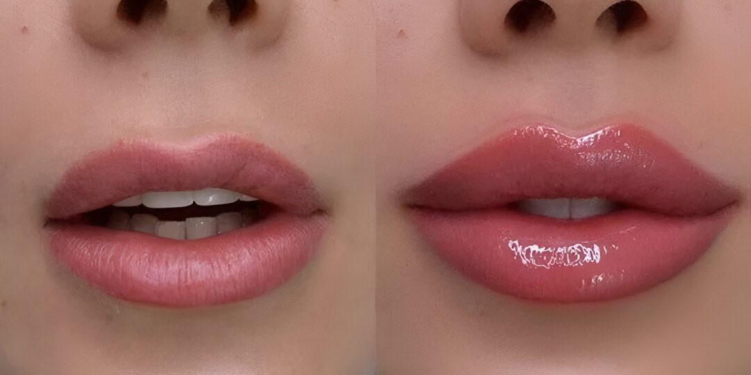 permanent-lip-augmentation-in-islamabad